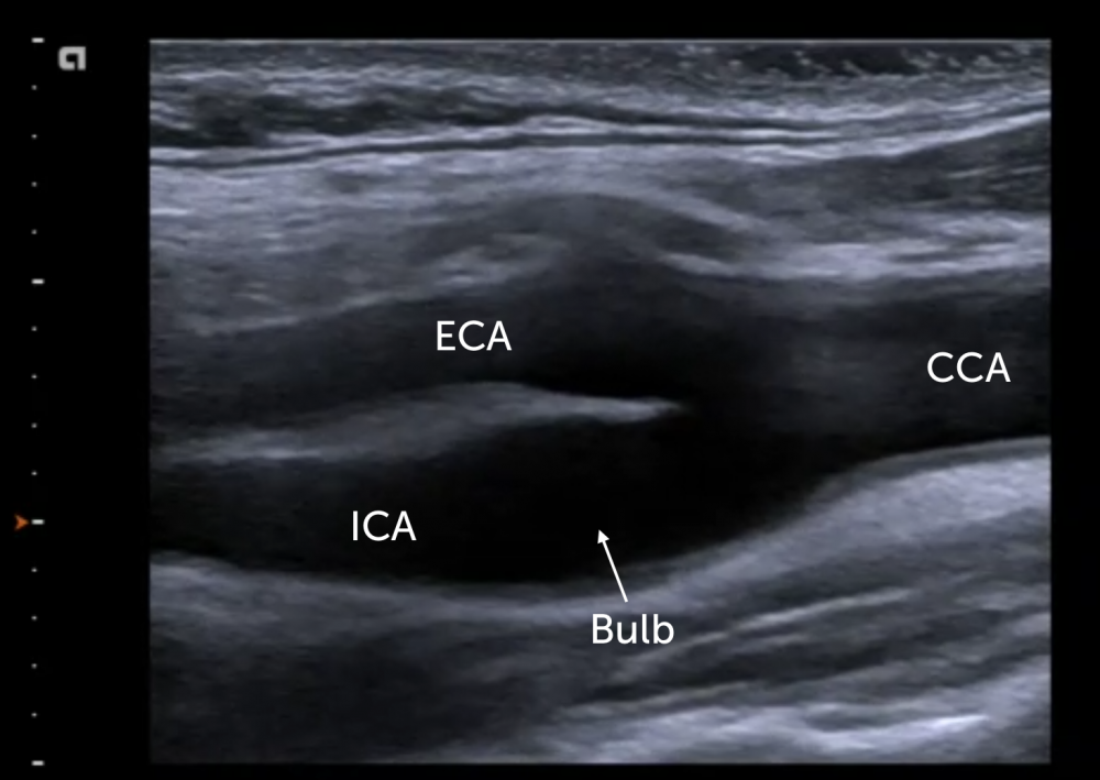 8-eca-vs-ica-external-versus-internal-carotid-artery-123-sonography